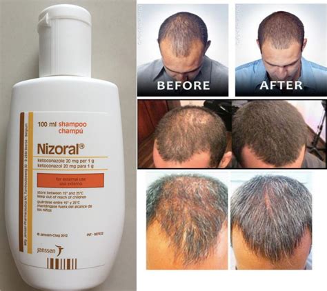 7 Nizoral Shampoo Secrets To Stop Hair Loss