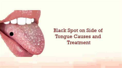 Black Spot On Tongue Astonishingceiyrs