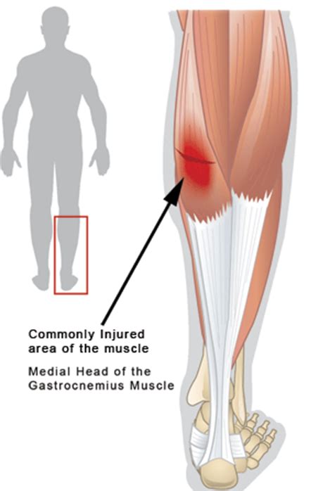 Calf Muscle Tear