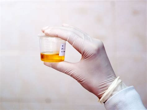 Creatinine Urine Test: Understanding 31.7Mg Results