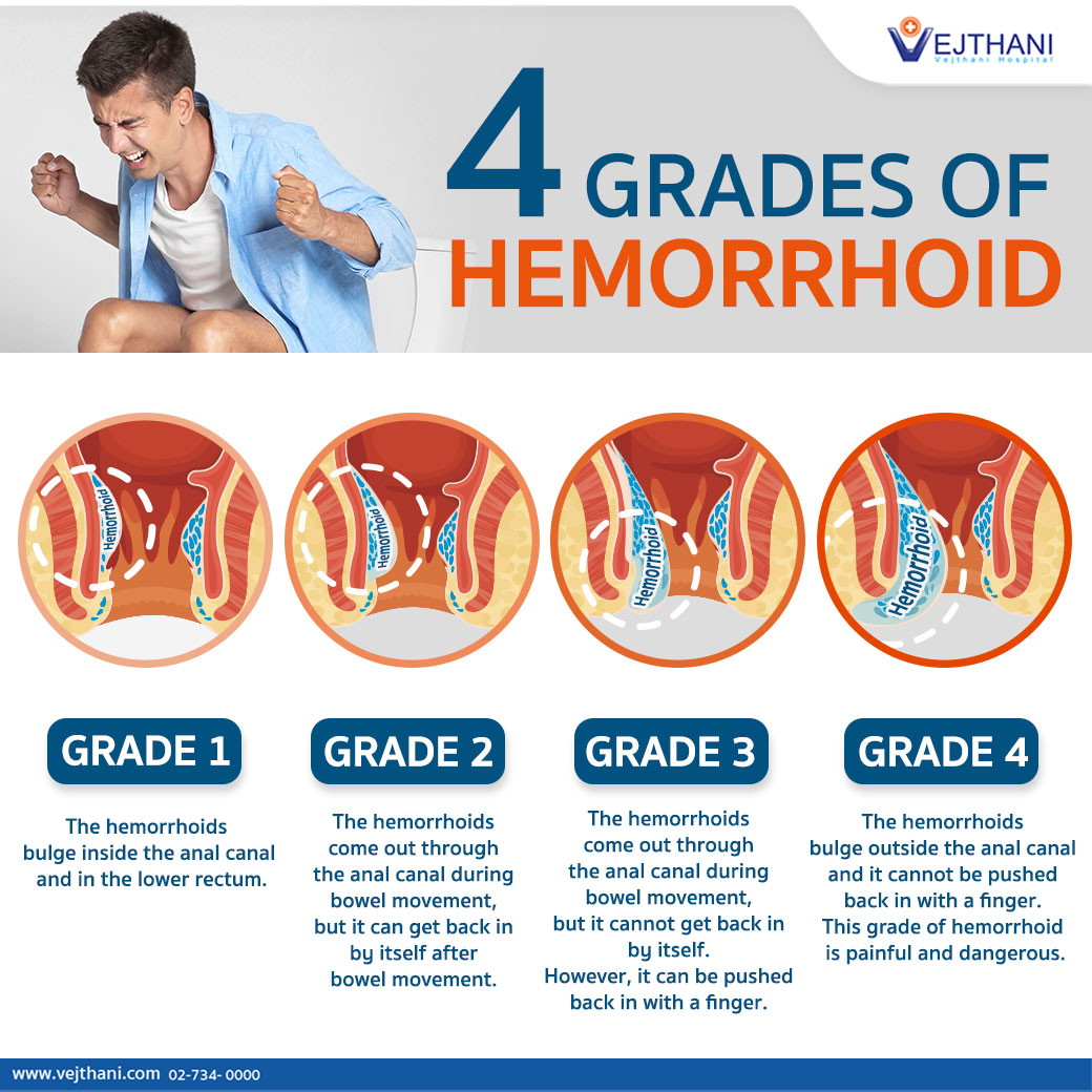 Do You Have Hemorrhoids How Severe Is Your Hemorrhoid