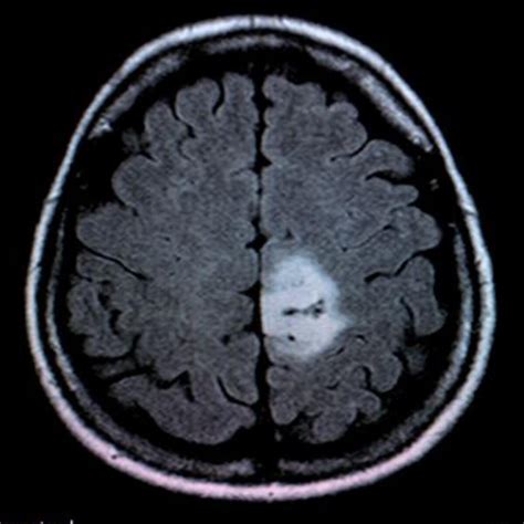 Healthcare Mri For Brain Tumor Kaggle