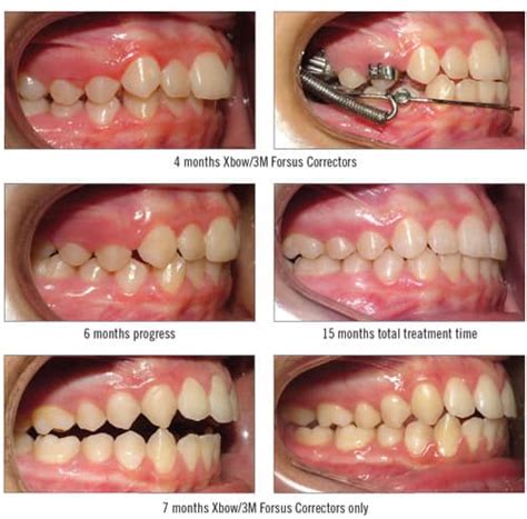 How Do Class Ii Correctors Work? Orthodontic Solutions