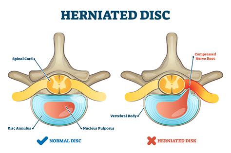 How Do I Know If My Herniated Disc Is Healing