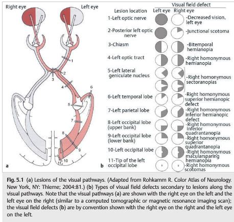 How Does Yale Treat Neuro Vision Loss? Effective Solutions