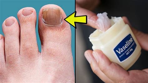 How To Fix White Toenails Fast?