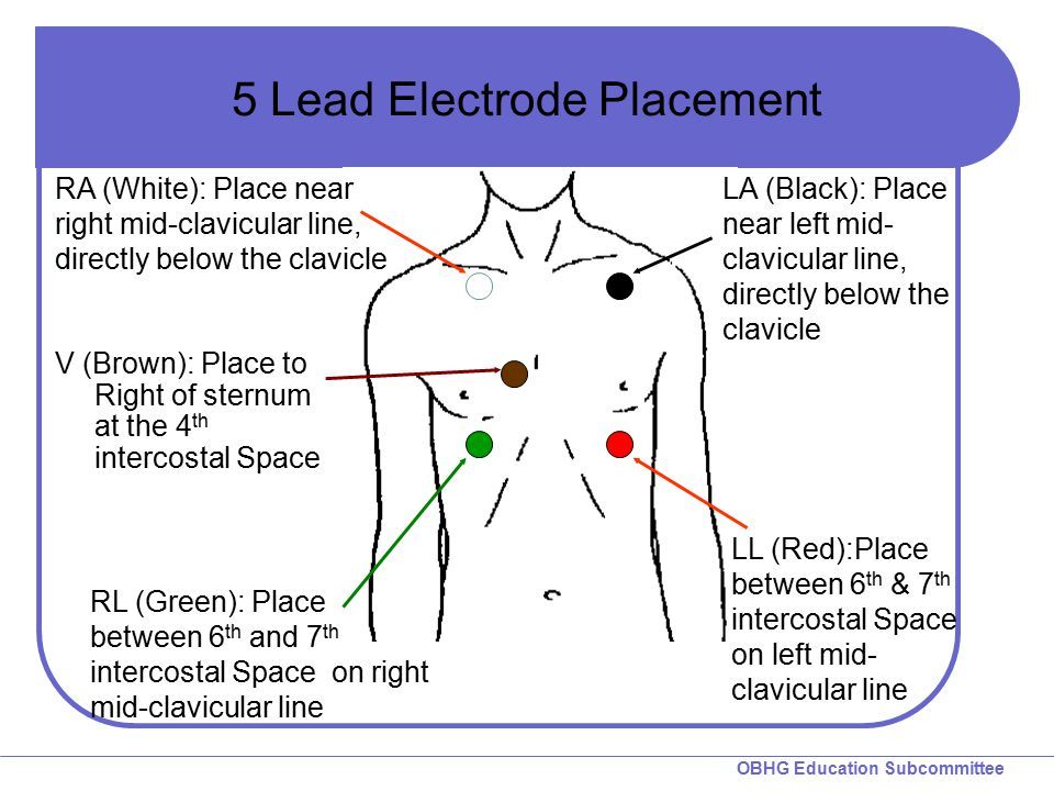 Proper 12 Lead Ekg Placement Diagram