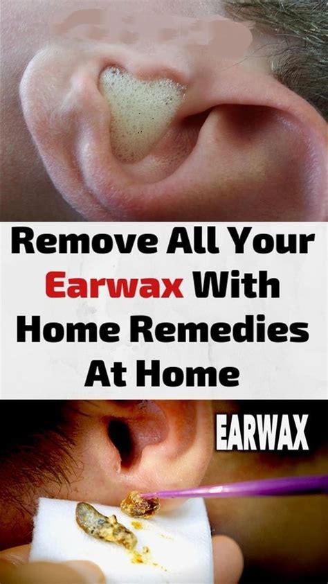 Remove All Your Earwax With Home Remedies At Home In 2020 Clean Ear