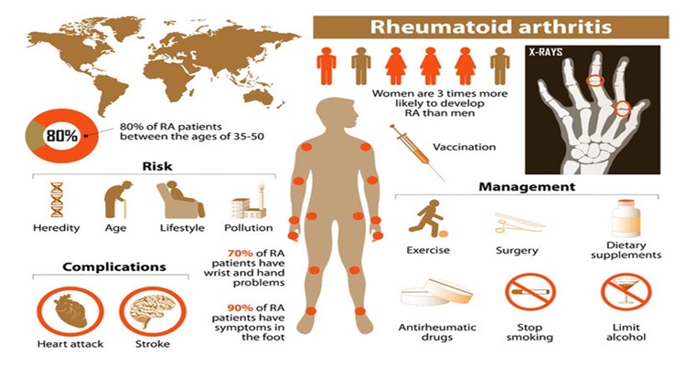 Rheumatoid Arthritis Treatment Natural