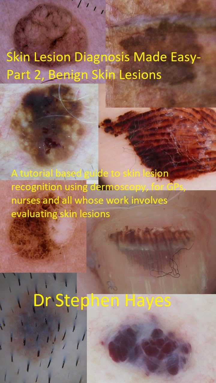 Skin Lesion Diagnosis Made Easy Part 2 Benign Skin Lesions A Tutorial