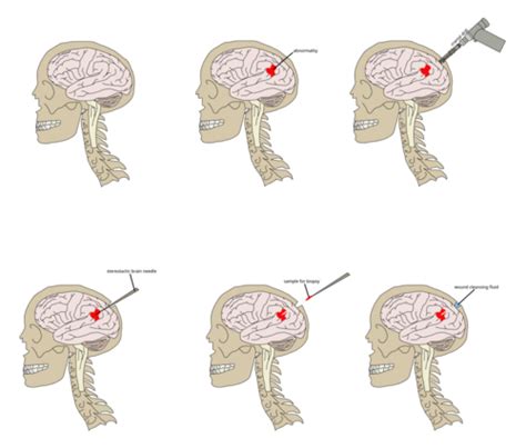 Stereotactic Brain Biopsy Cl Nica Neuros Neurocirujano Valencia