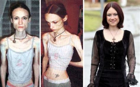 Stunning Before And Afters Of People Who Conquered Anorexia