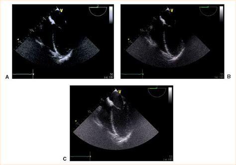 Techniques And Tricks For Optimizing Transesophageal Images Radiology Key