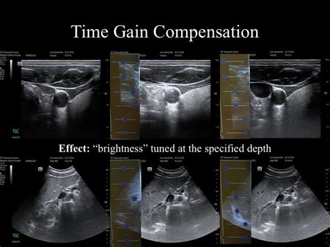 Time Gain Compensation