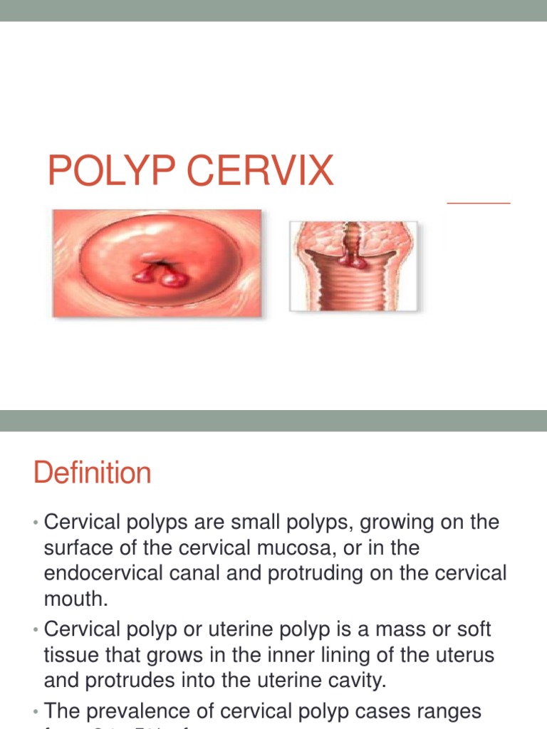 What Are Cervical Polyps Cervical Polyp Cervix The Best Porn Website