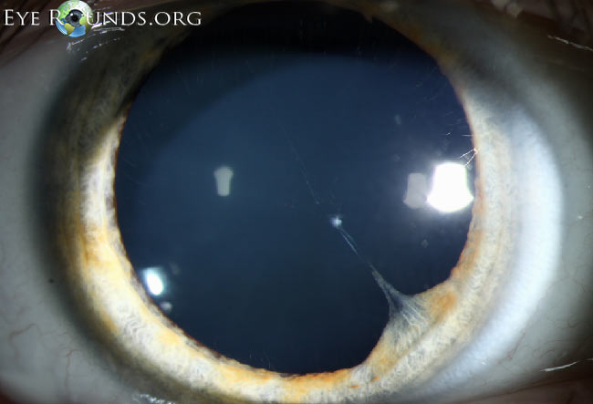 What Causes Persistent Pupillary Membrane? Treatment Options